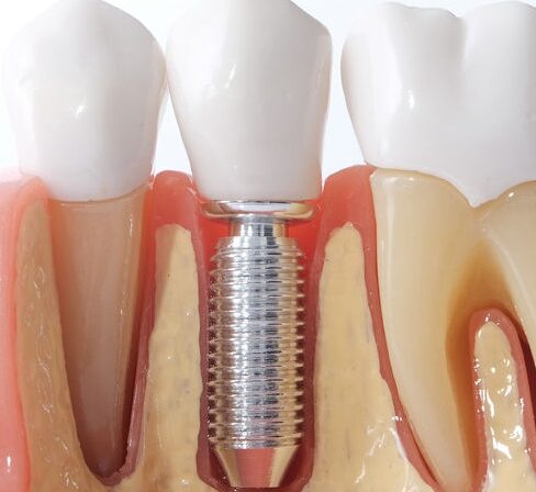 Implants