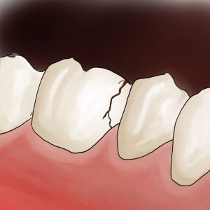 What you need to know if you have a Crack Tooth?