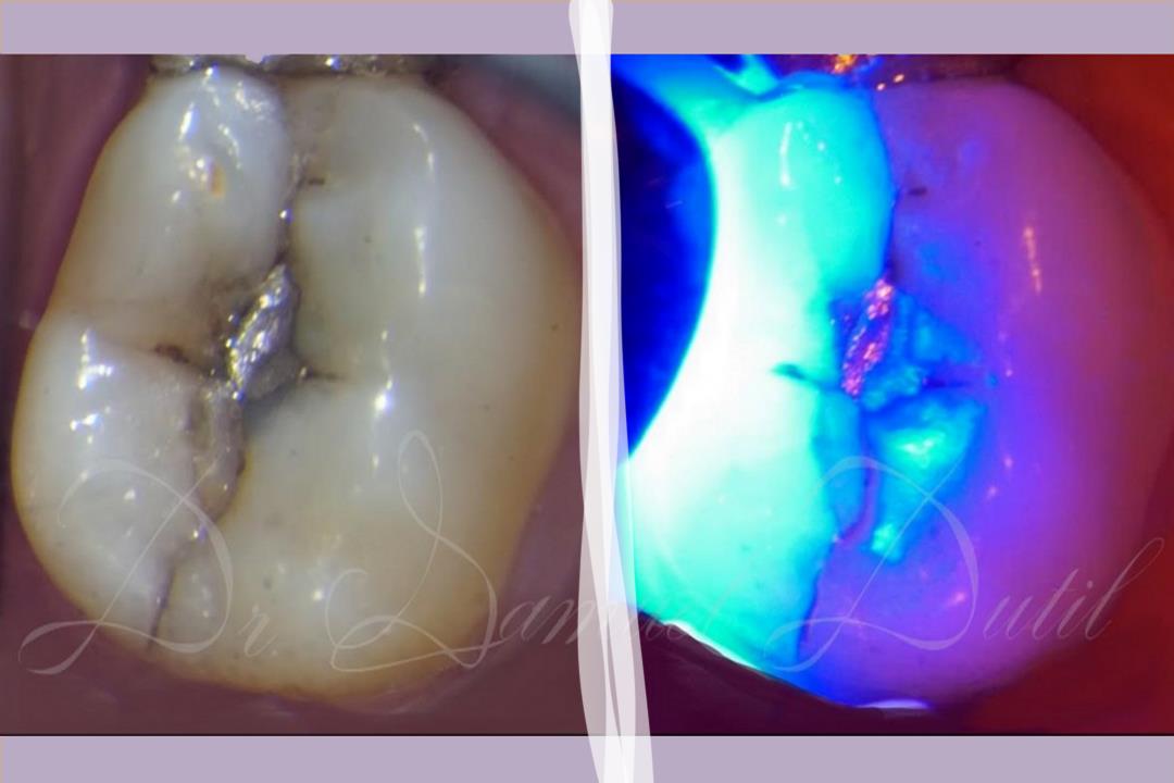 What you need to know if you have a cracked tooth?